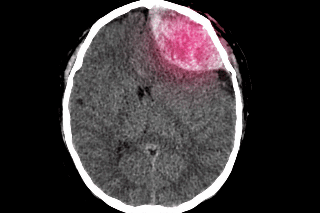 Define Pituitary Tumor Craniotomy Explained