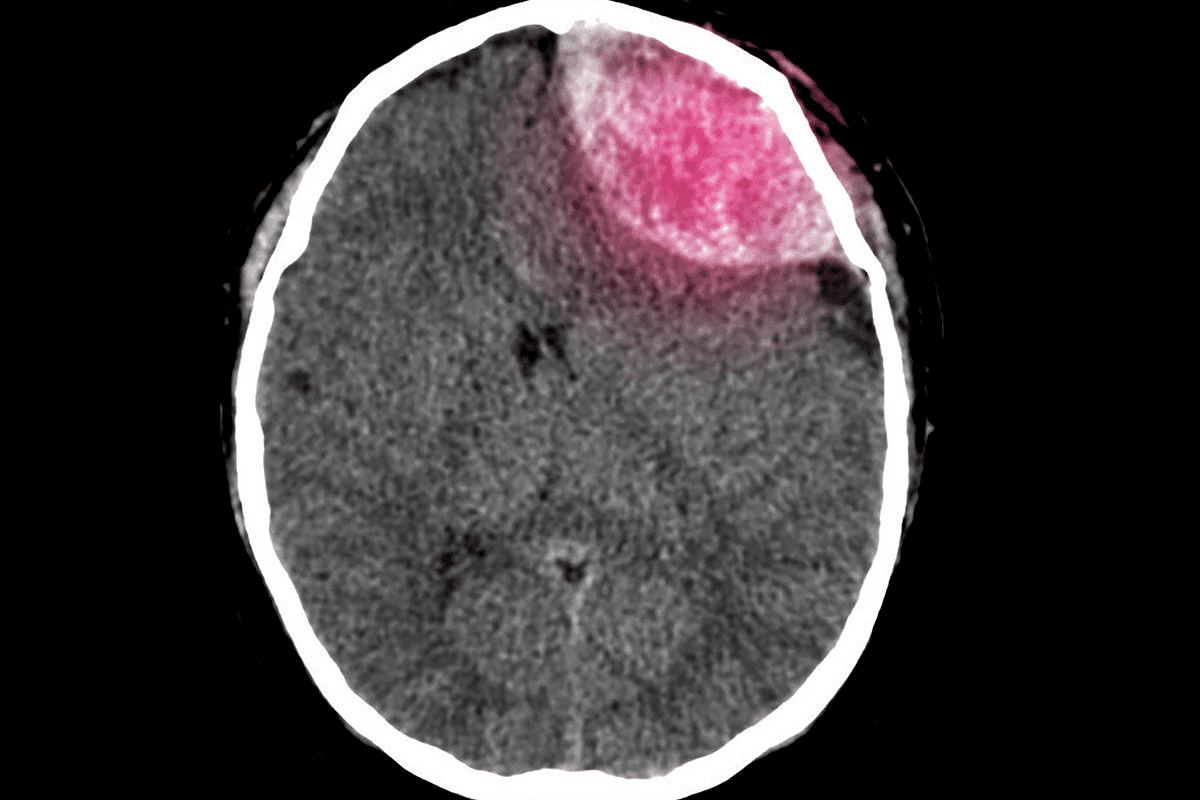 Define Pituitary Tumor Craniotomy Explained