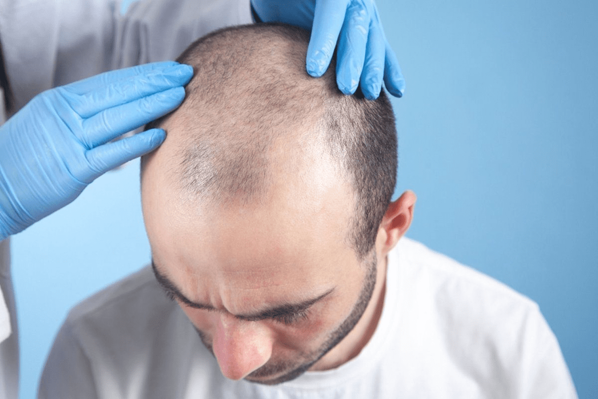 Key Timeline for Hair Growth After Craniotomy