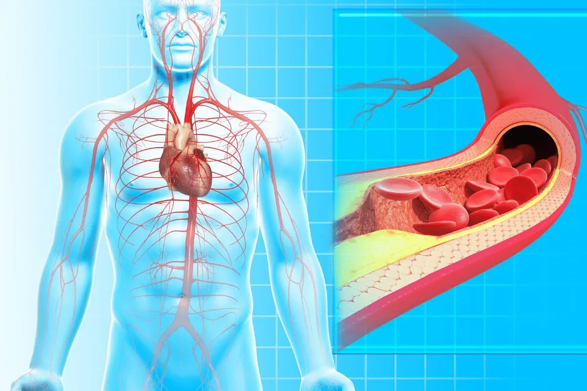 Define Endarterectomy: Can Plaque Be Removed With Endarterectomy?