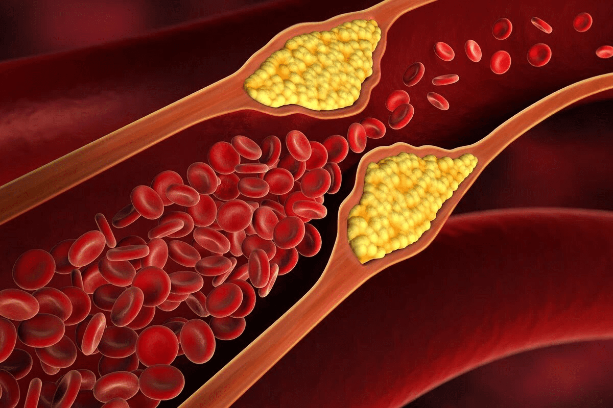 Key ICD 10 Code For Carotid Endarterectomy