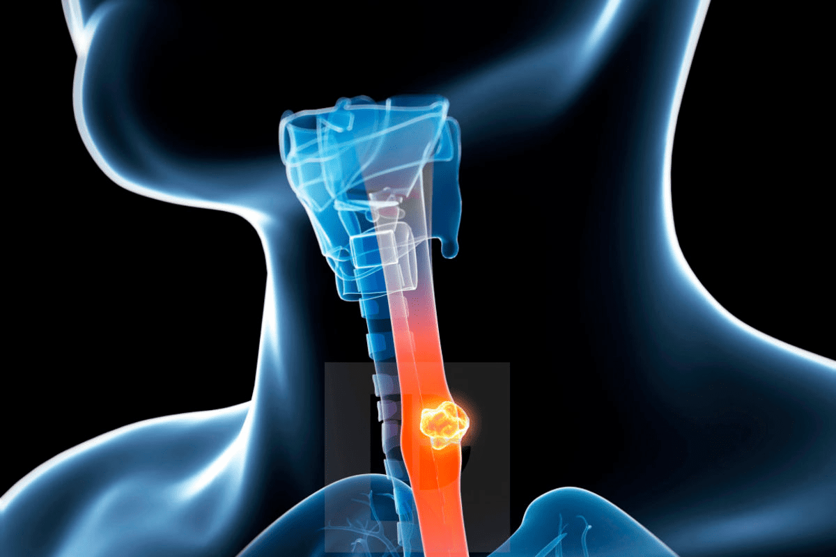 Crucial Life Expectancy With Blocked Carotid Artery