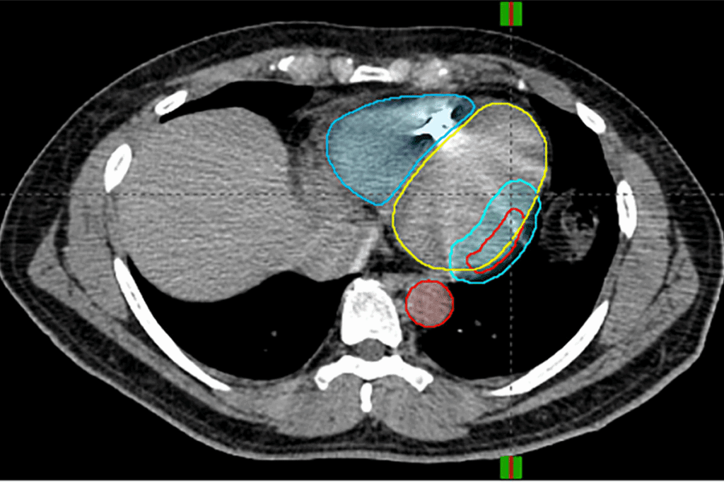 Define Gamma Knife Surgery Procedure
