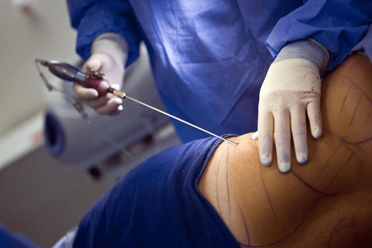 Long Stay Abdominal Surgery: Why It Takes 2 Weeks