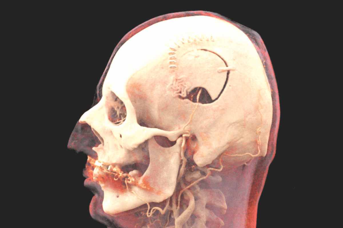 Key Risk: Csf Leak After Craniotomy Commonality