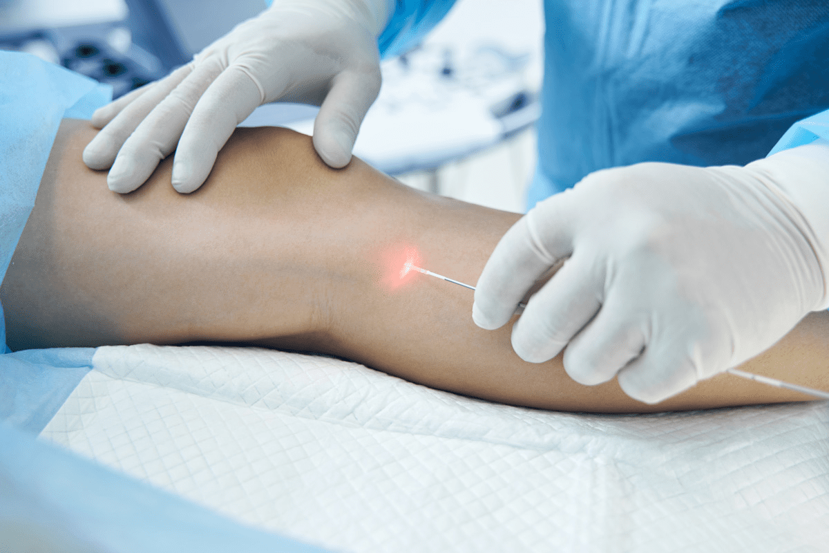 Laser Ablation Success: Real Outcomes & Results