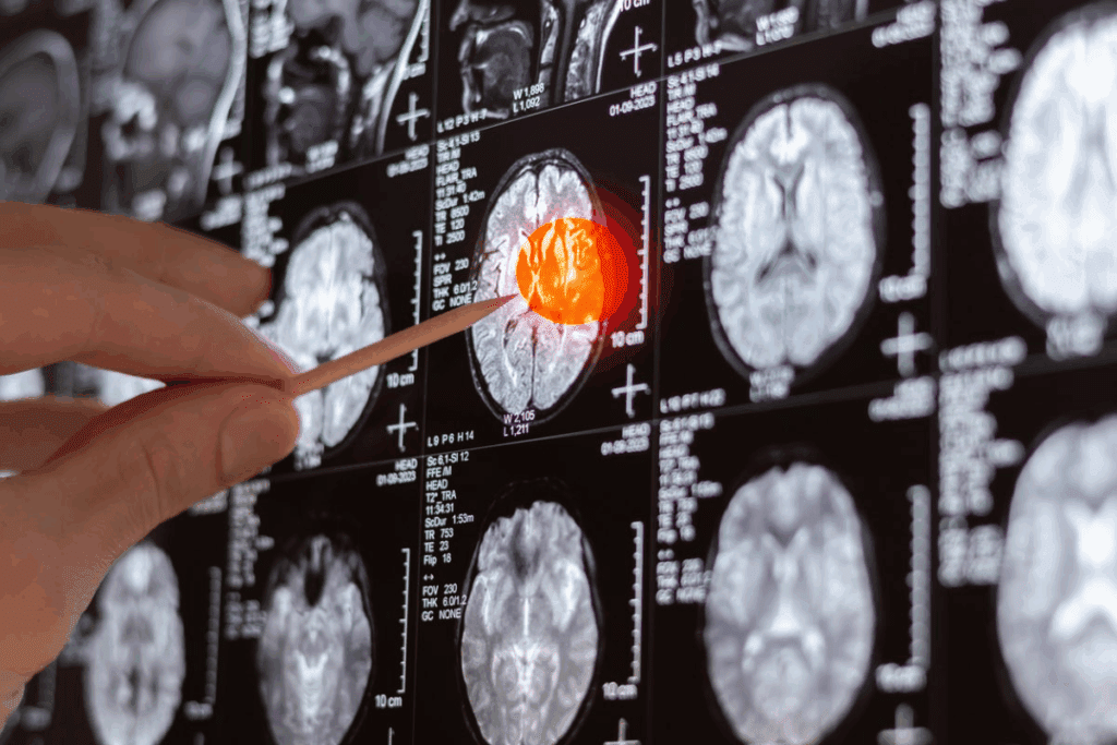 Crucial Risks Of Brain Stem Surgery Explained