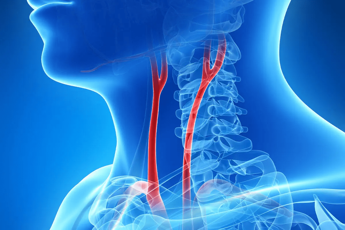 What is carotid artery disease and how is it diagnosed? Carotid artery disease happens when the carotid arteries, which carry blood to the brain, get narrowed or blocked. This is due to plaque buildup. Doctors use imaging tests like ultrasound, CT angiography, or MRI angiography to diagnose it. What is the difference between TCAR and CEA? TCAR (Transcarotid Artery Revascularization) is a less invasive procedure. It involves stenting the carotid artery through a small neck incision. CEA (Carotid Endarterectomy) is a surgical method that removes plaque from the artery. TCAR is seen as a less invasive option compared to CEA. What are the benefits and risks of carotid artery stenting (CAS)? CAS is a minimally invasive procedure that keeps the carotid artery open with a stent. It offers a quicker recovery and less risk of complications compared to CEA. But, it also comes with risks like stroke, bleeding, and stent thrombosis. Who are ideal candidates for TCAR? TCAR is best for patients at high risk for CEA complications. This includes those with severe medical conditions or certain anatomical features. It's also suitable for patients who've had previous neck surgery or radiation therapy. What is the recovery process like after TCAR? After TCAR, patients usually spend a short time in the hospital and then rest at home for several weeks. They might feel some discomfort, bruising, or swelling at the incision site. These symptoms usually go away on their own. What are the possible complications of TCAR and other carotid procedures? Complications of TCAR and other carotid procedures include stroke, bleeding, infection, and reactions to the stent or materials used. While serious complications are rare, they can be life-threatening. How do I choose the right treatment approach for carotid artery disease? Choosing the right treatment depends on the disease's severity, your overall health, and personal preferences. It's important to talk to a healthcare provider and consider getting a second opinion. What are the costs associated with carotid artery treatment, and how can I navigate insurance coverage? The costs of carotid artery treatment vary based on the procedure, location, and insurance. Patients should check with their insurance to understand coverage and out-of-pocket costs. Are there any new or experimental treatments for carotid artery disease? Yes, new treatments for carotid artery disease are being researched and developed. This includes emerging technologies and techniques. Patients should discuss these options with their healthcare provider and learn about clinical trials. Can carotid artery disease be managed with medication alone? In some cases, medication and lifestyle changes can manage carotid artery disease. This includes controlling high blood pressure, cholesterol, and diabetes. But this approach may not work for everyone. Patients should talk to a healthcare provider about their options.