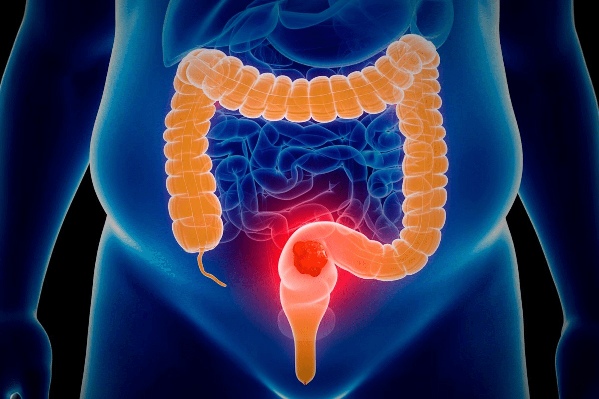 Bowel Resection Done Laparoscopically: Benefits & Procedure