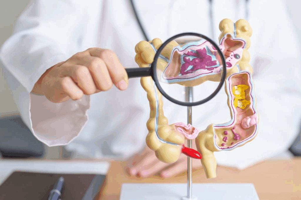 What is the Life Expectancy After Bowel Resection Surgery?