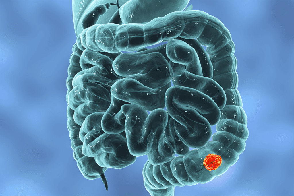 What is the Life Expectancy After Bowel Resection Surgery?