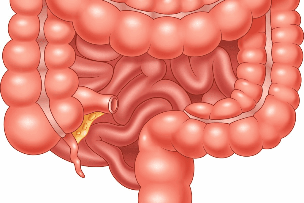 Colectomy Hospital Stay Duration: Expert Facts