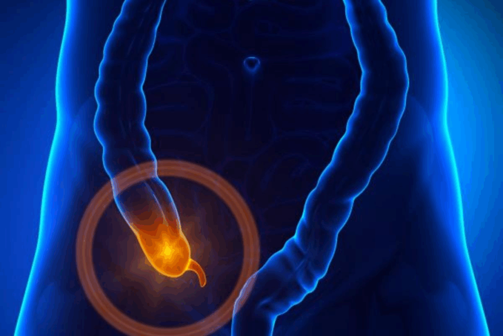 Returning to Work After Appendectomy