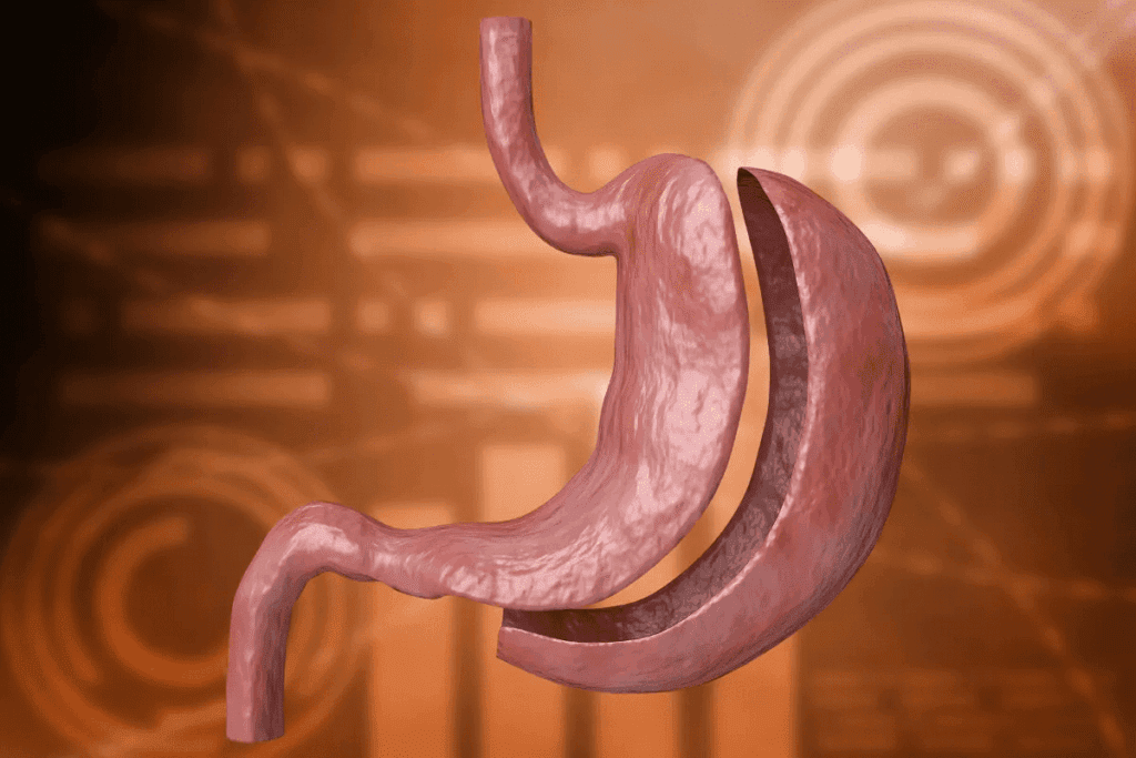 Gastric Bypass Surgery: The Ultimate Guide