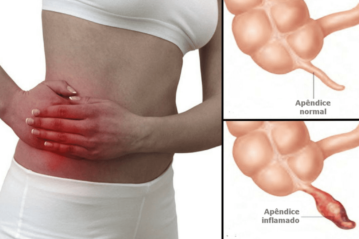 Causes of Appendicitis Explained