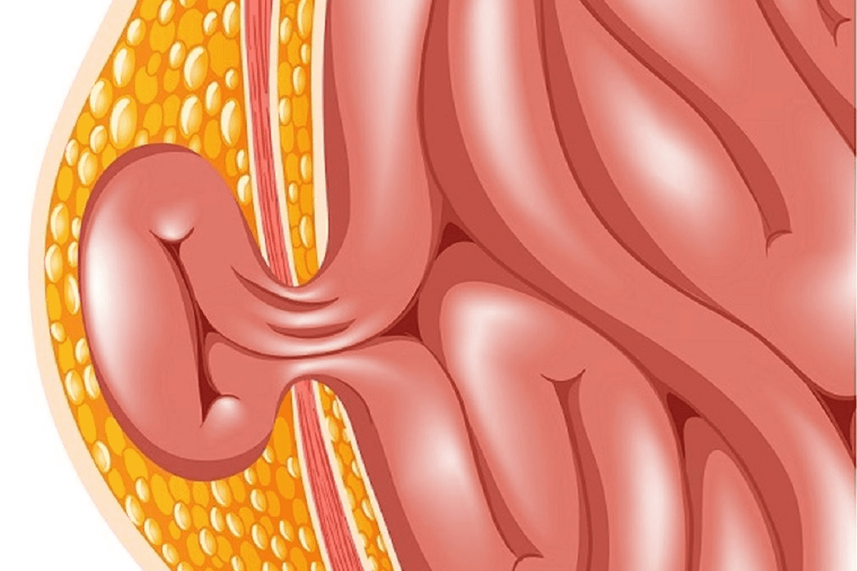 Lumpectomy Pain: Surprising Facts on Recovery