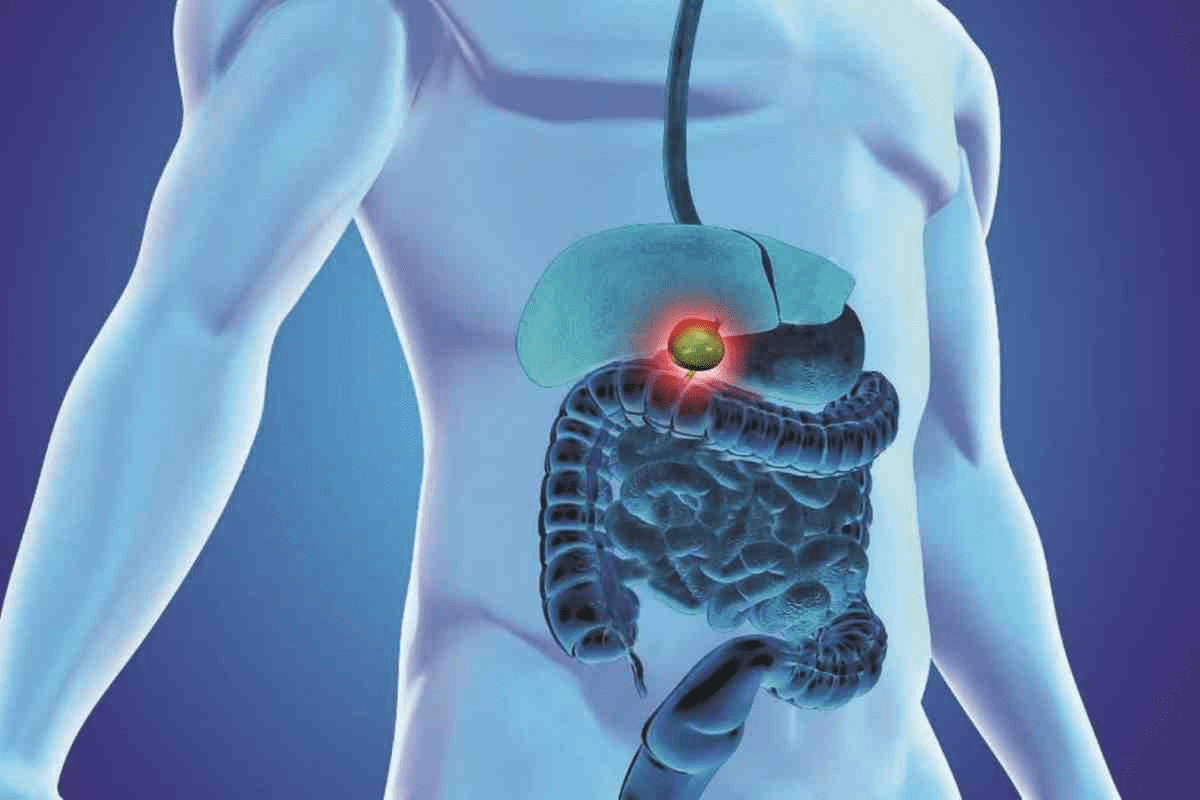 Dumping Syndrome After Gallbladder Removal Guide