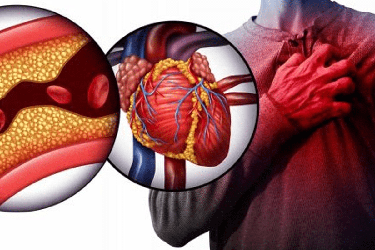 Insightful Can You Recover From Heart Disease: Prognosis