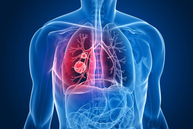 is 90 treatment success for lung cancer possible 8n354 1 LIV Hospital