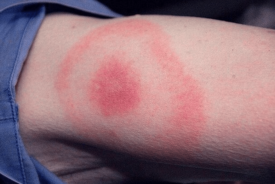 Kelly Osbourne Lyme Disease