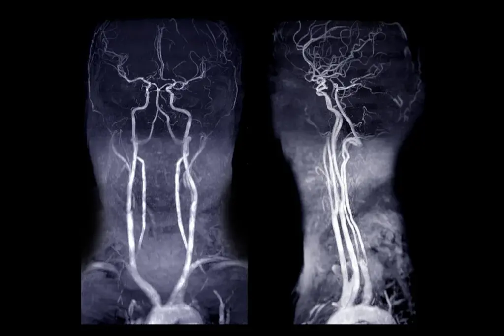 PAD MRI Detection Imaging: Clear Results