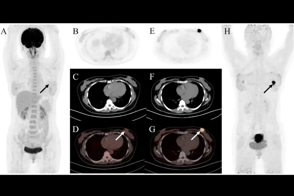 Key Role of CT Imaging Cardiomyopathy Detection