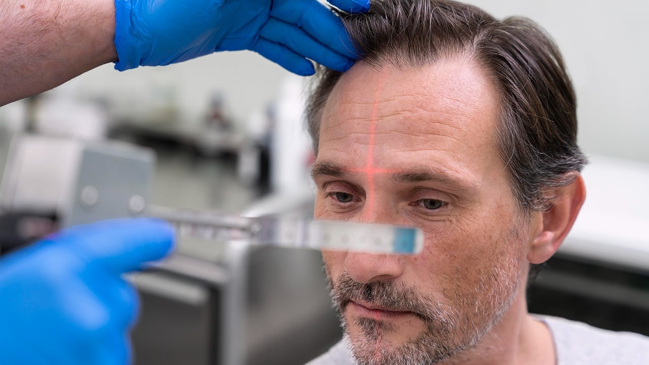 man getting hair loss treatment 1 yt thumbnail 1280 720 LIV Hospital