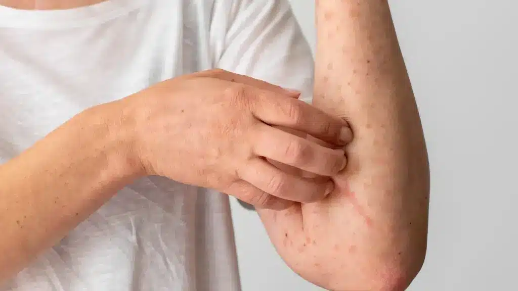 skin allergy reaction person s arm yt thumbnail 1280 720 1 LIV Hospital